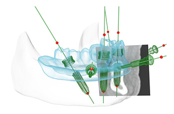 NobelGuide® / NobelClinician™