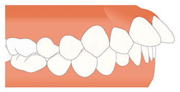 上顎前突（出っ歯）