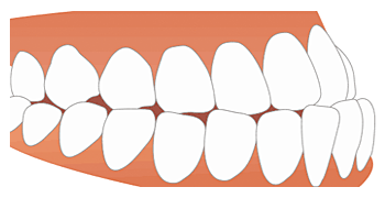 下顎前突（受け口）