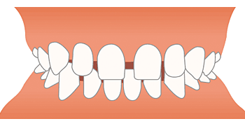 空隙歯列（すきっ歯）