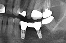 インプラントの症例